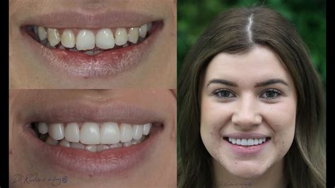 teeth veneers australia.